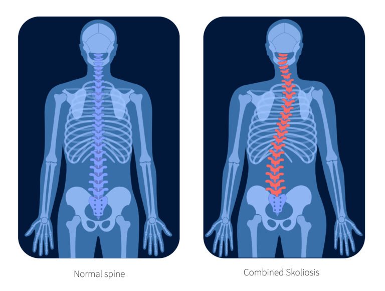 Άσκηση και Σκολίωση